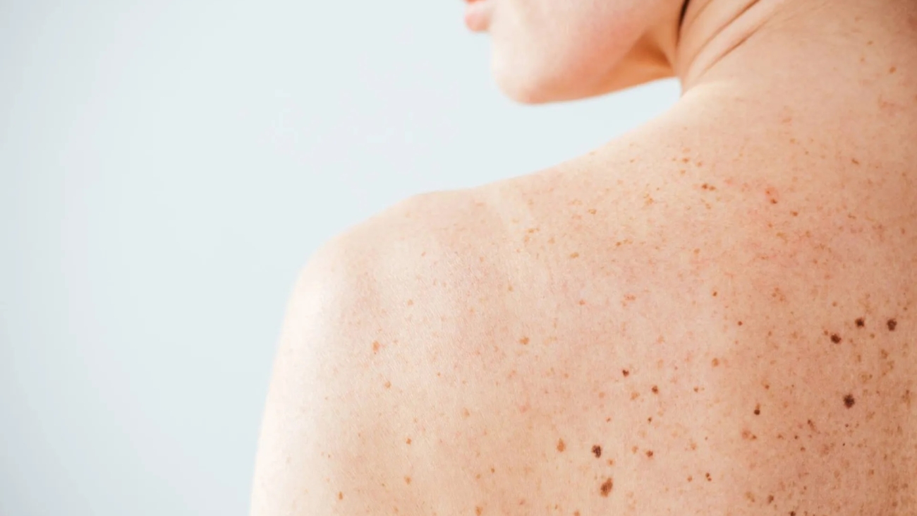 melanoma-pelle-neo-marina-conese-dermatologa