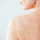 melanoma-pelle-neo-marina-conese-dermatologa
