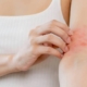 dermatologia-acne-eczema-psoriasi-trattamenti-dermatologici-pelle-marina-conese